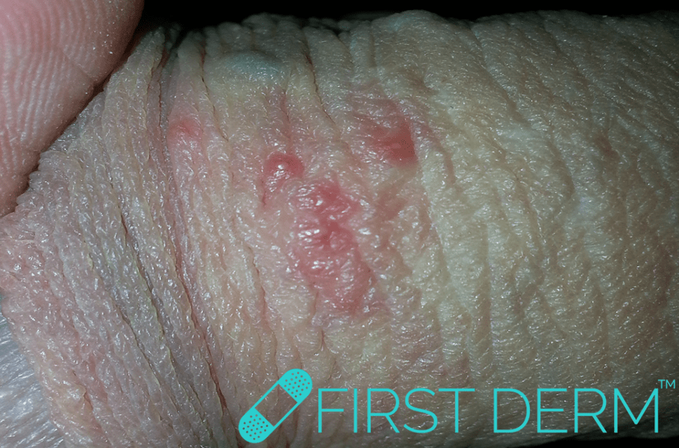 Sex rash Genital Herpes Simplex Virus (HSV) penis ICD 10 A60.0.