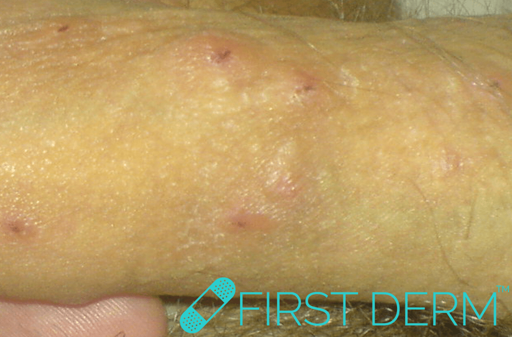 Sex rash itchy Scabies (Sarcoptes scabiei) penis ICD 10 B86.0
