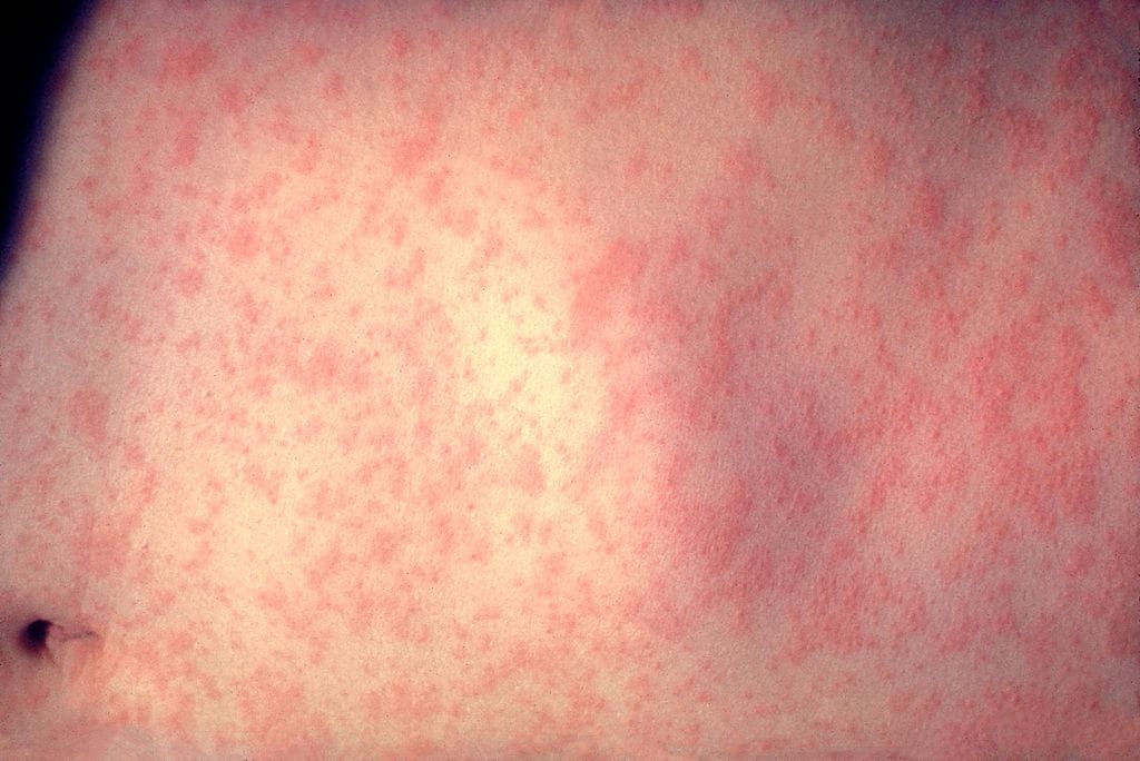 measles-exanthem