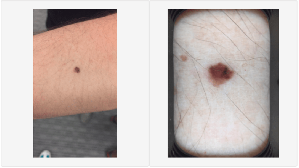 Hudcancer: är du i riskzonen? - fråga en hudläkare med First Derm