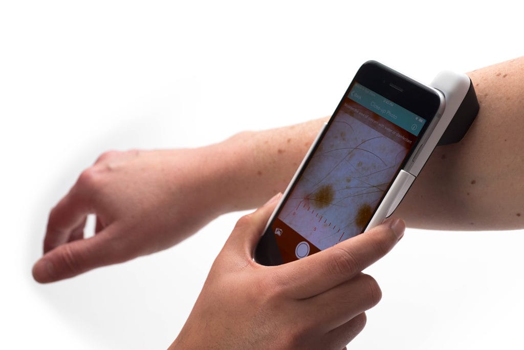 melanom føflekkreft HUD smarttelefonen
