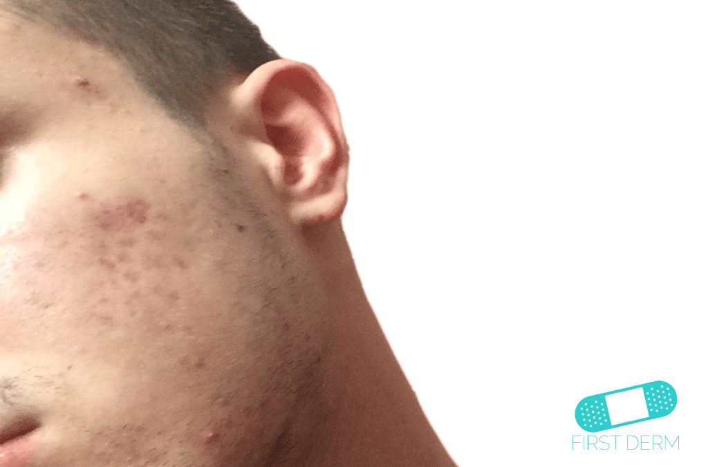 Summer Skin Care: Treating Post-Inflammatory Hyperpigmentation
