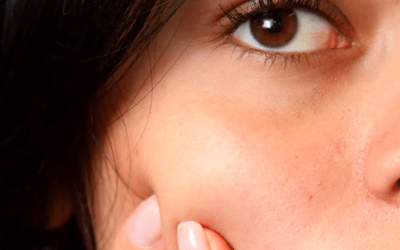 Hautpflege im Sommer: Behandlung eines postinflammatorischen Erythems