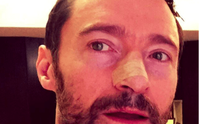 Hugh Jackman – Hans Femte Tecken På Hudcancer