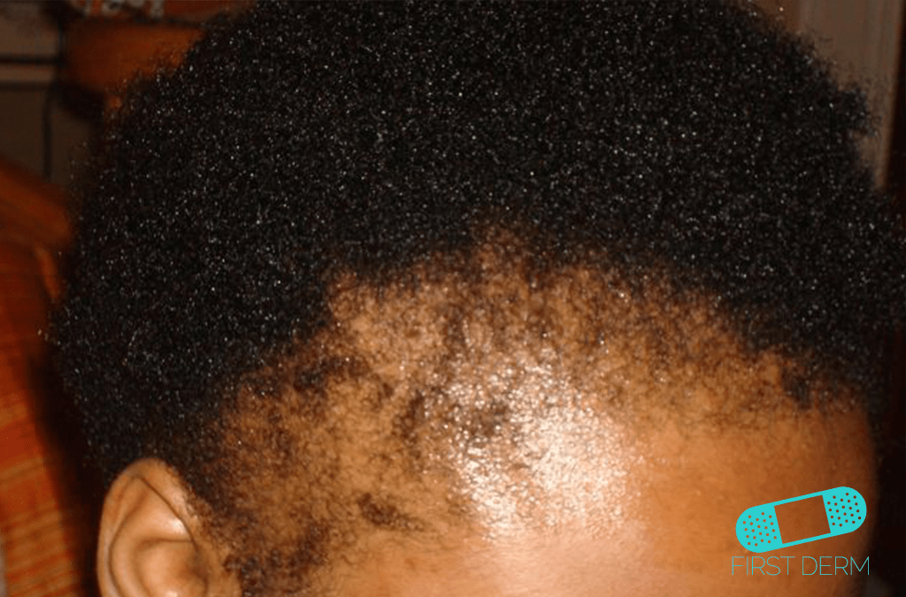 Black Skin Conditions and their treatment Hair Traction Alopecia ICD-10-L65.2
