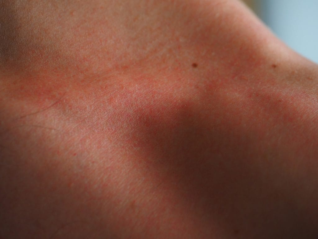 Rosacea control sensitive skin neck