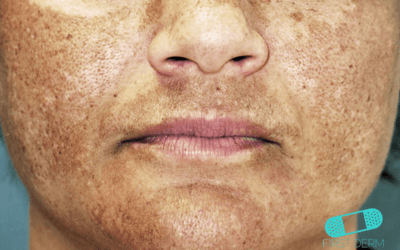 Melasma (Cloasma)