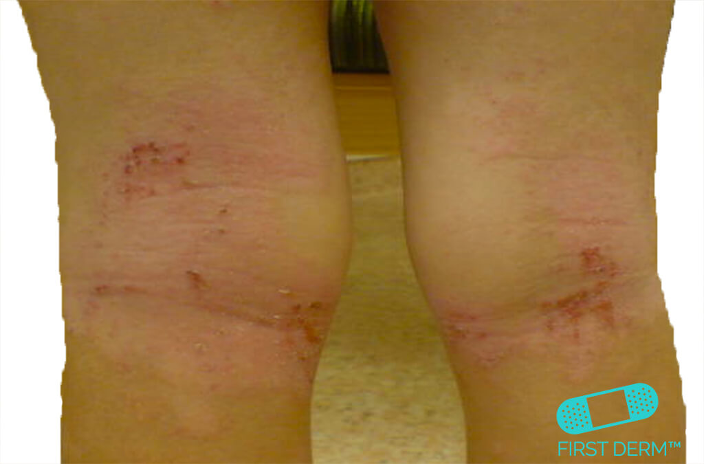 Atopic Eczema knee sensitive skin