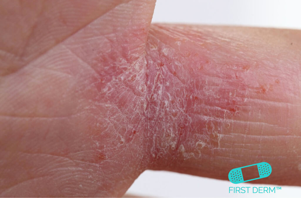 Itchy Rash Pictures, Causes and Treatment