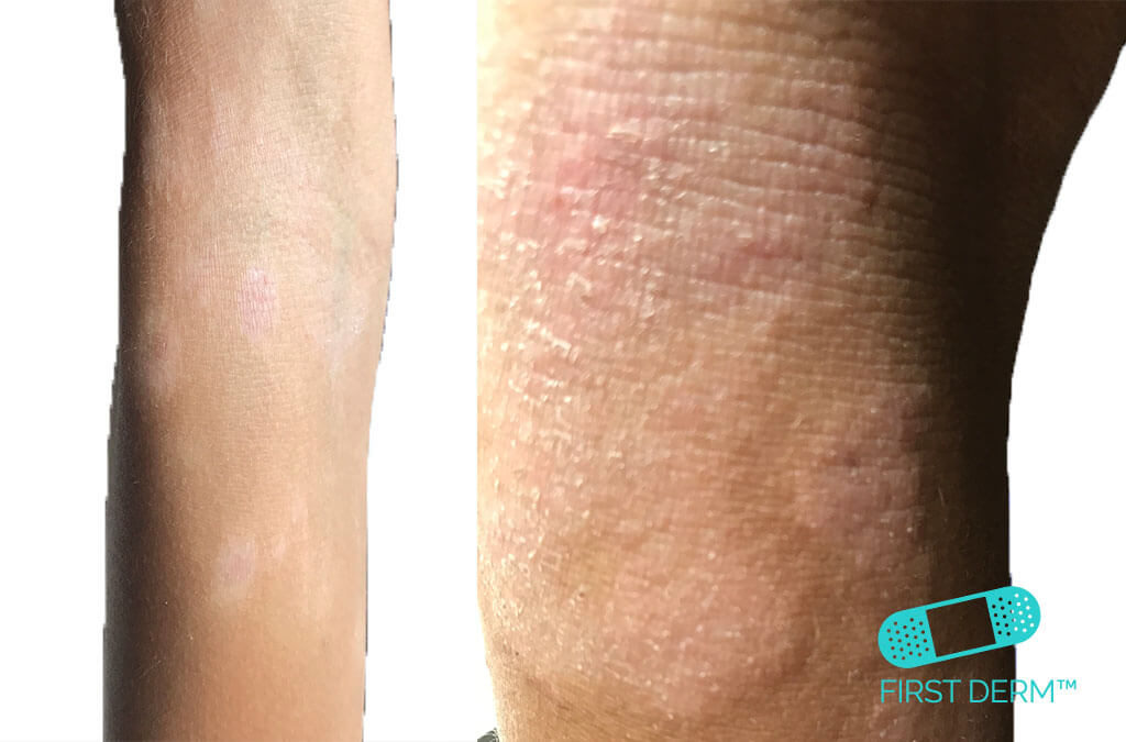 Kliande hud bilder atopisk dermatit eksem barn arm ICD 10 L20.9