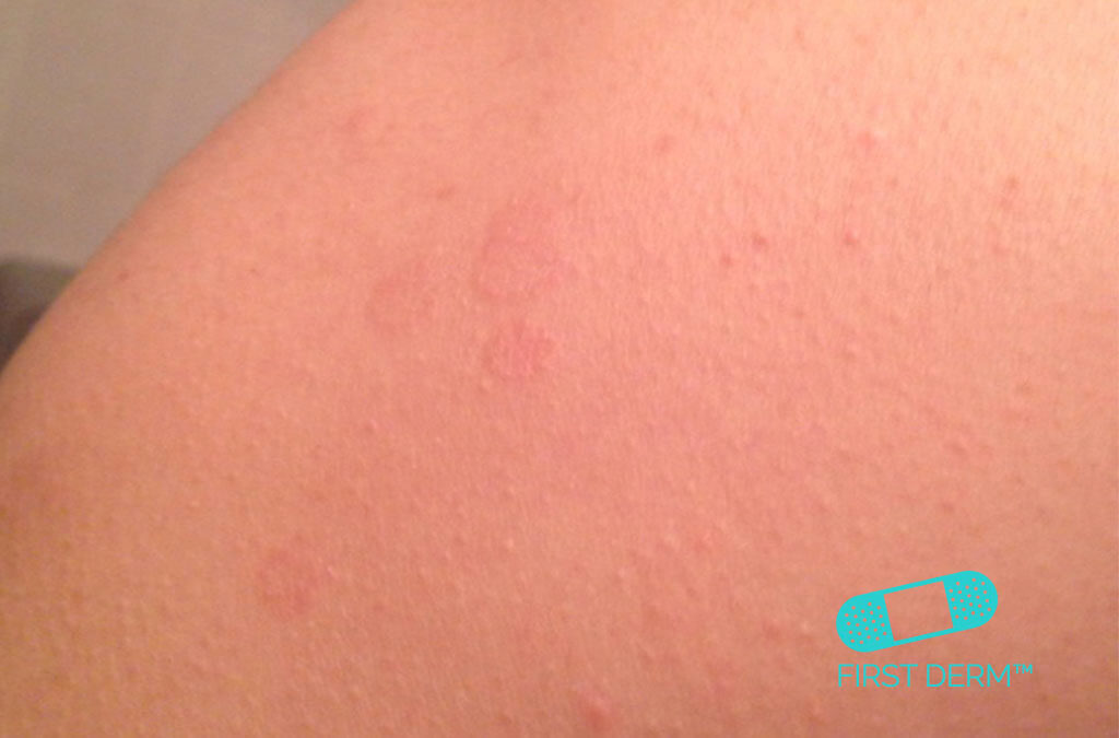 Red spots on skin Pityriasis versicolor Tinea on back ICD 10 B36