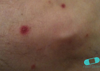 Acne Vulgaris Icd 10 Photos Download Jpg Png Gif Raw Tiff Psd Pdf And Watch Online