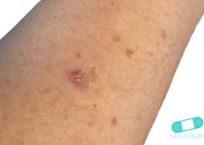 Actinic Keratosis AK Online Dermatology actinic-keratosis-ak-online-dermatology