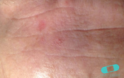 Queratosis Actínica
