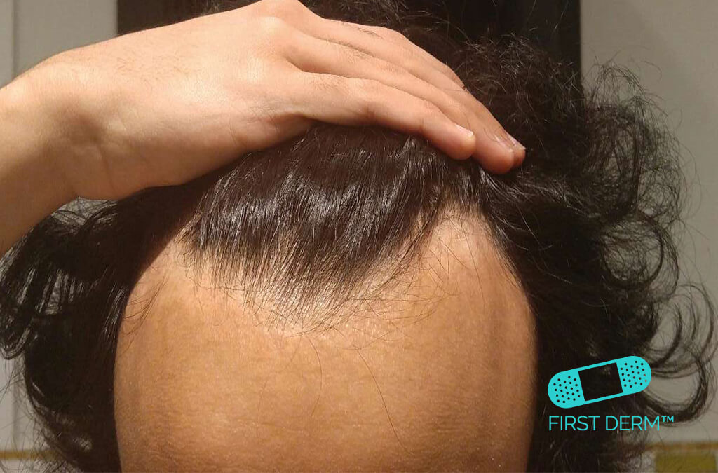 Alopecia areata - hair loss - Syptoms Causes & Treatments ICD 10 L63.9