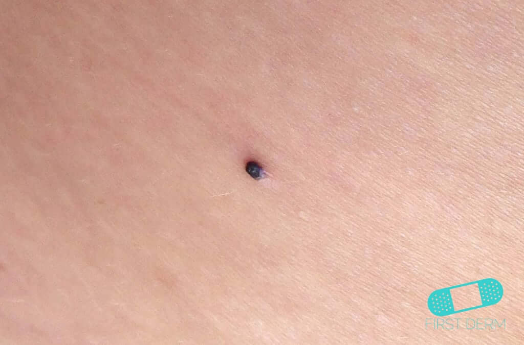 Angioma Online Dermatology