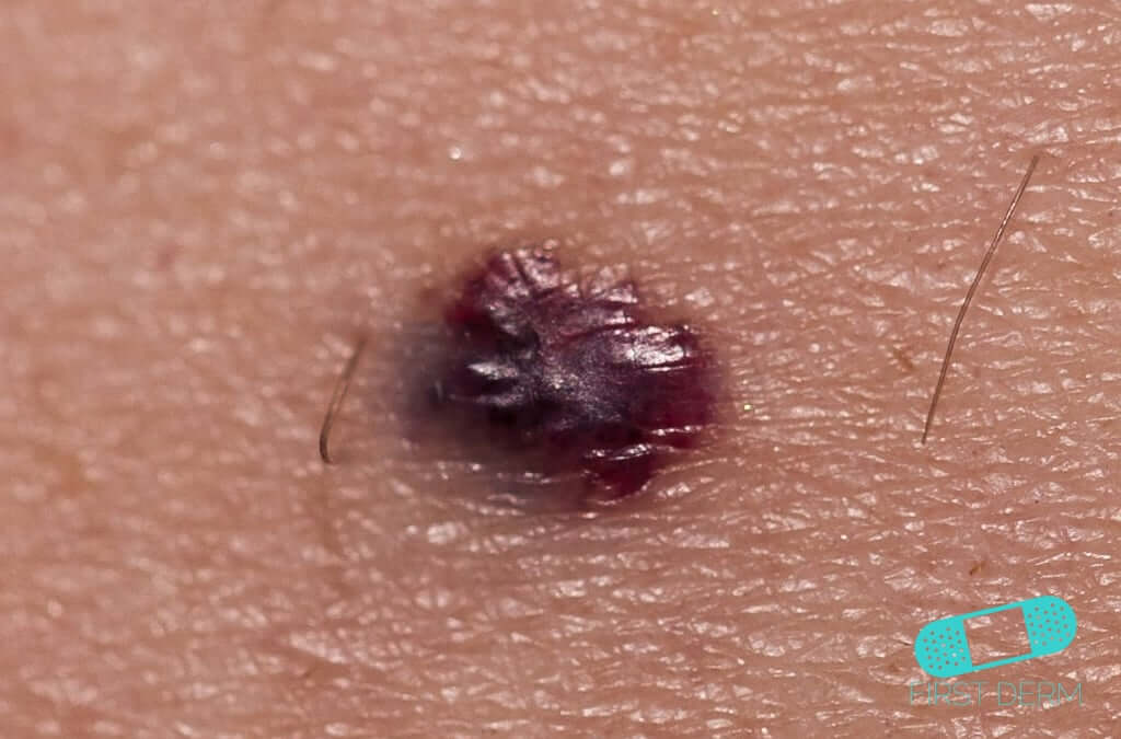 Angioma Online Dermatology