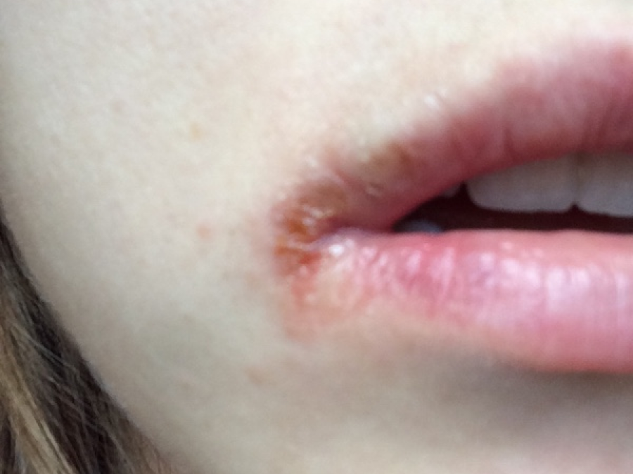 Angular cheilitis