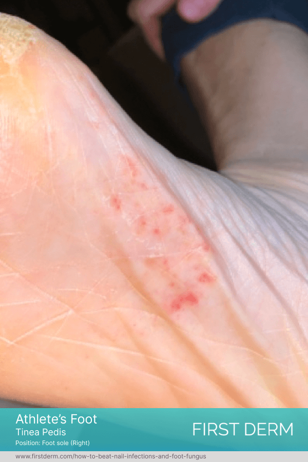 Foot sole infected with fungal Athlete's foot infection, displaying symptoms of red, scaling, and itchy skin, potentially accompanied by fungal nail infection