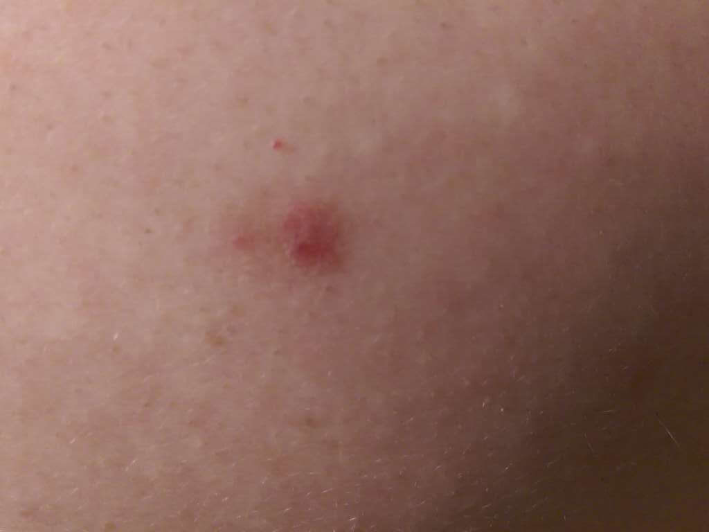Basal cell carcinoma picture (basalioma) high quality image back shoulder