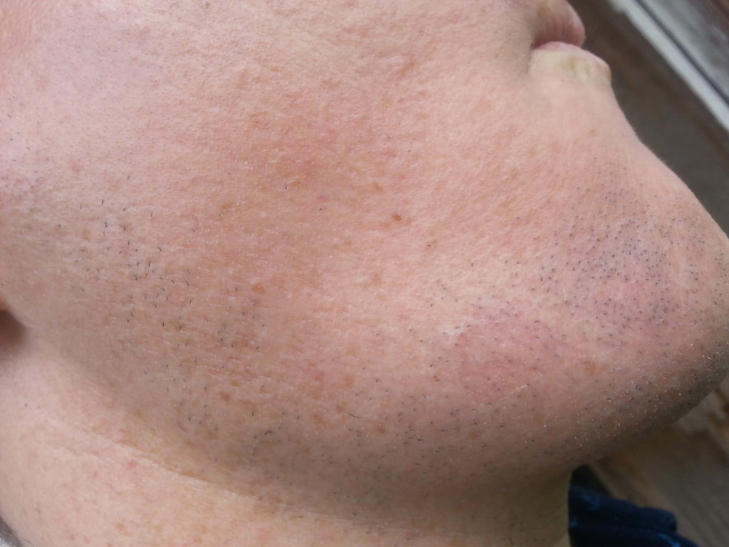 Basal cell carcinoma picture (basalioma) high quality image chin