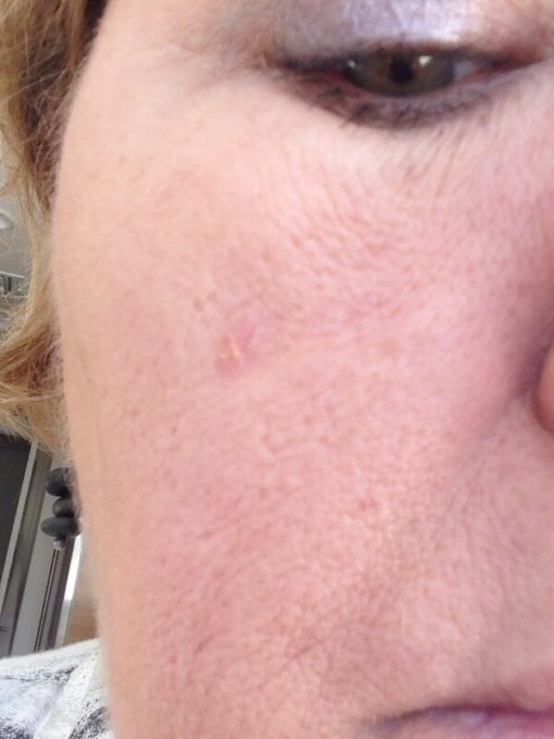 Basal cell carcinoma basalioma pictures cancer photos Dermatology