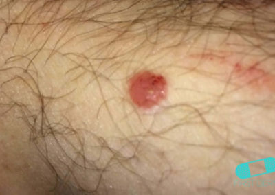 Basal cell carcinoma (Basal cell skin cancer, BCC) (03) groin [ICD-10 C44.91]