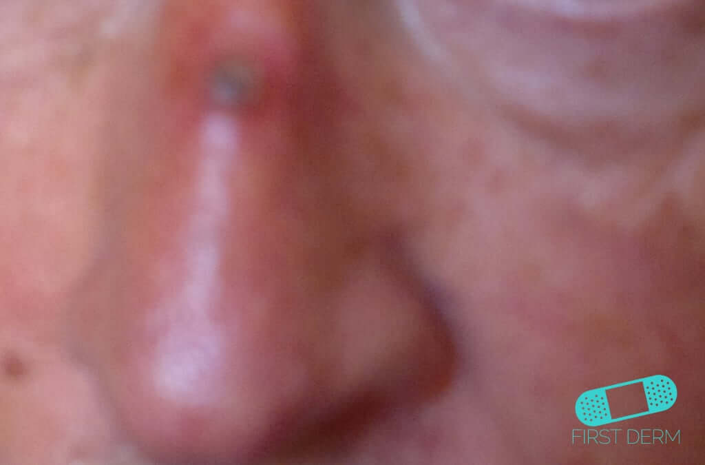 Basal cell carcinoma (Basalioma skin cancer, BCC) - Online ...