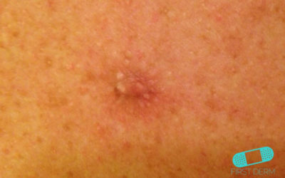 Basalcellscancer (basaliom)