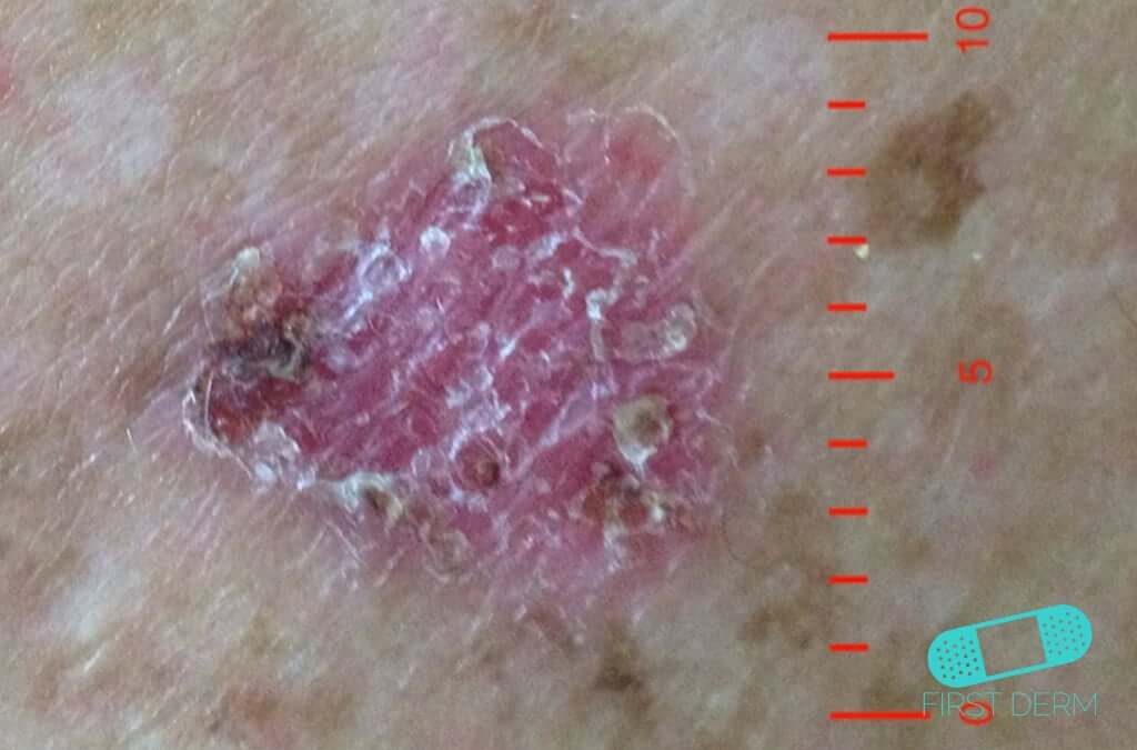 Hudläkare på nätet Basalcellscancer (basaliom)