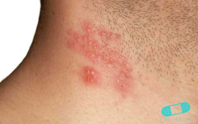 Bältros (herpes zoster)