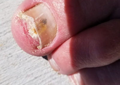 Common nail discoloration fungal infection