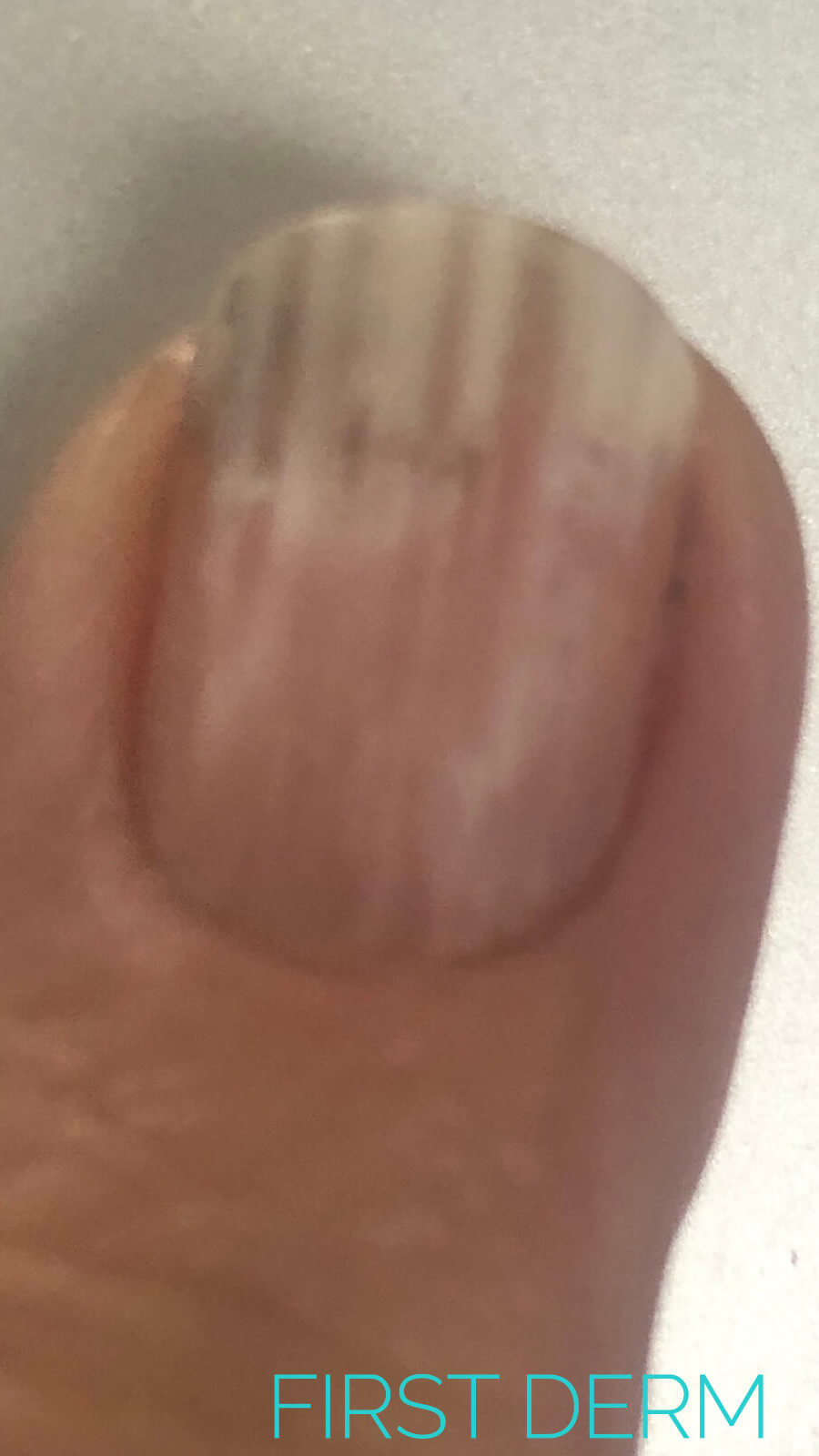 Common nail discoloration -