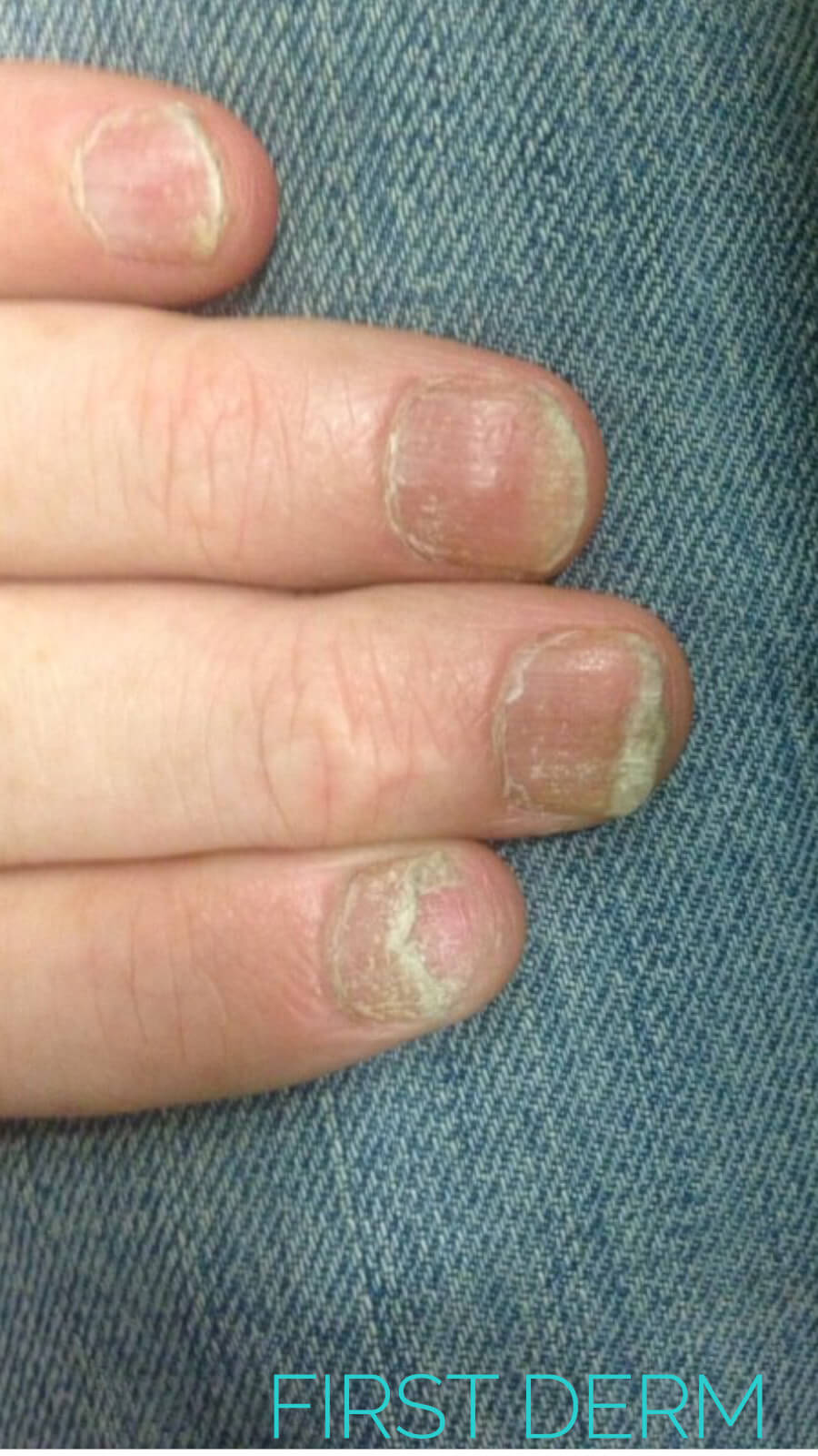 Common nail discoloration -