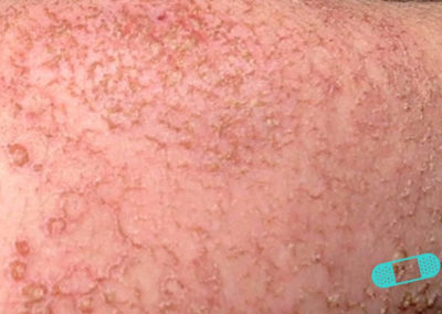Contact Dermatitis (02) skin [ICD-10 L25.9]