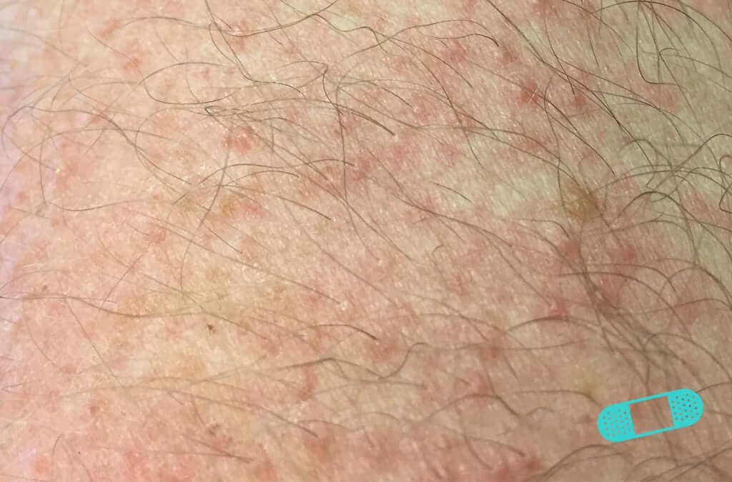 Contact Dermatitis Online Dermatology