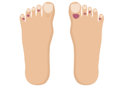 covid-toes-rash