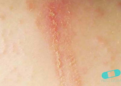 Dermatitis de Contacto (01) piel [ICD-10 L25.9]