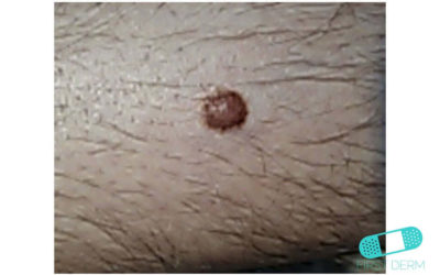 Dermatofibroma (Histiocitoma)