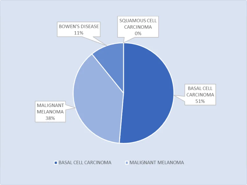 An image of a pie chart showing the differential count of identified skin malignancies through the First Derm skin cancer screening platform. The chart has three segments of different colors, one for each type of skin cancer. The chart has two main divisions marked as basal cell carcinoma and malignant melanoma. The largest segment is for basal cell carcinoma, with 51% of the total. The second largest segment is for malignant melanoma, with 38% of the total. The smallest segment is for squamous cell carcinoma, with 0% of the total. The other segment is for Bowen’s disease, with 11% of the total.
