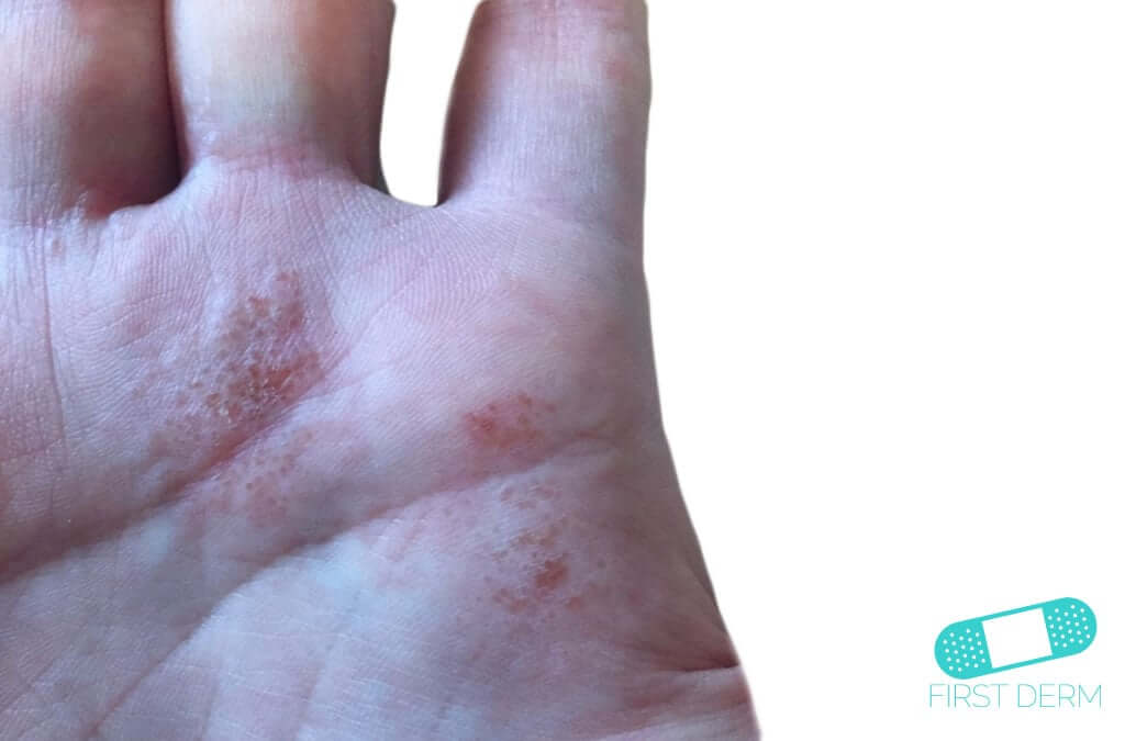 Dyshidrotic eczema (dyshidrosis) Online Dermatology