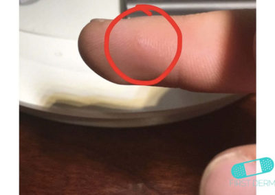 Eczema Dishidrótico (Dishidrosis) (04) dedo de mano [ICD-10 L30.1]