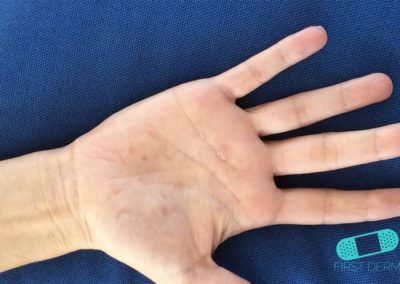 Eczema Dishidrótico (Dishidrosis) (02) mano [ICD-10 L30.1]
