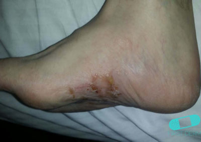 Eczema Dishidrótico (Dishidrosis) (03) pie [ICD-10 L30.1]
