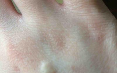 Epidermal cyst – clogged sebaceous gland