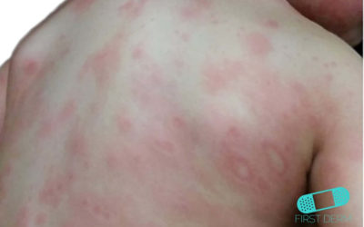 Erythema multiforme