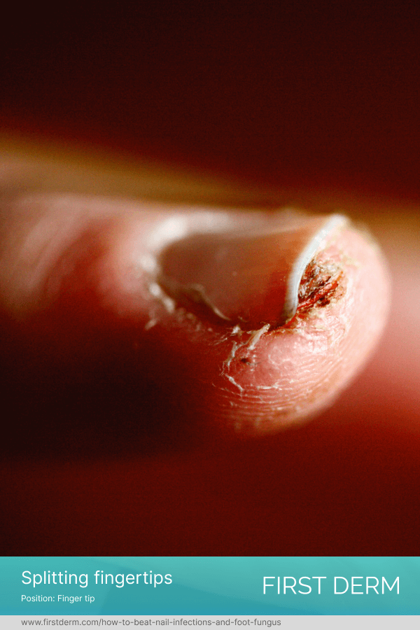 Skin Fissures and Split Fingertips | First Derm