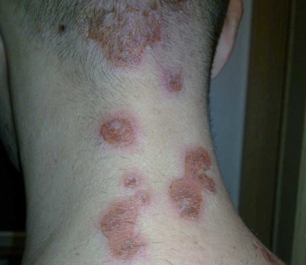 Wrestling Rashes the most common and how to treat them