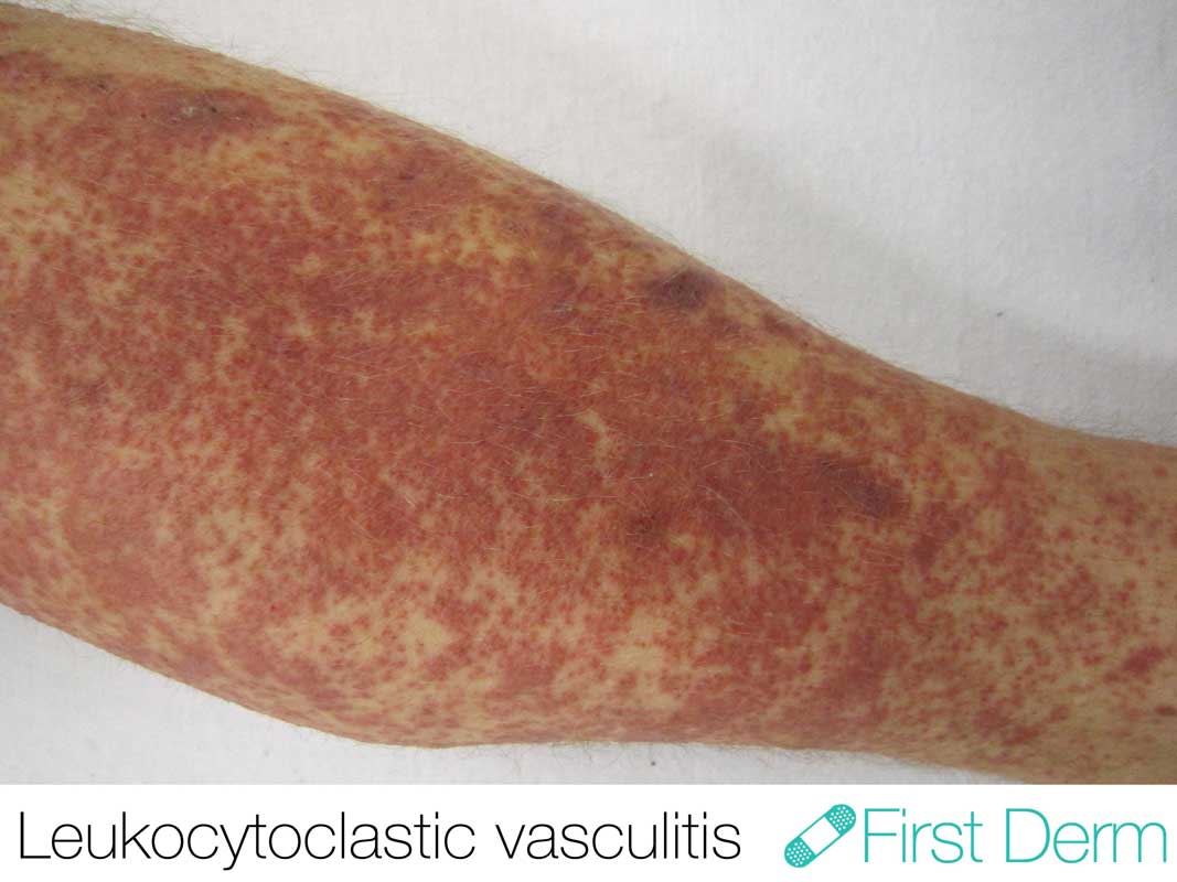 Vasculitis (Vasculitis Leucitoclástica)