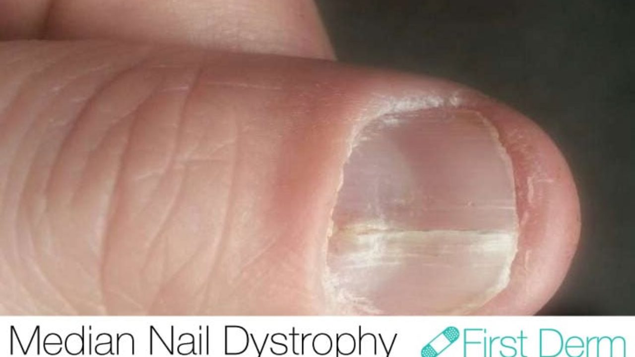 Median Nail Dystrophy -